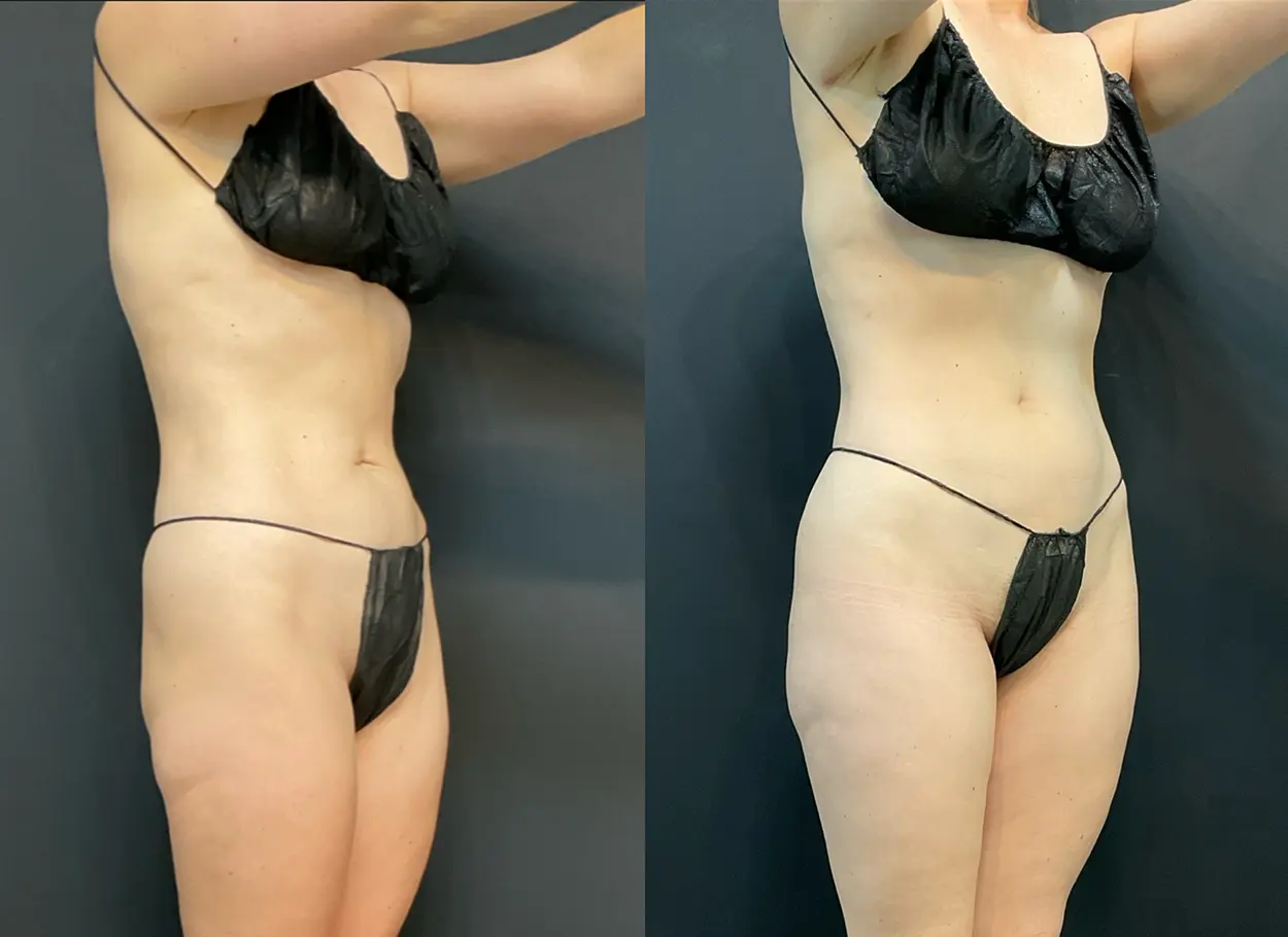 reverse-tummy-tuck-06