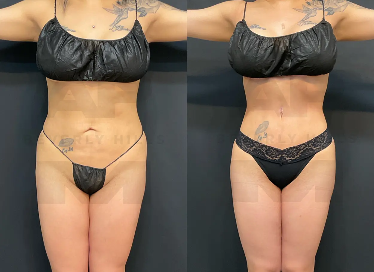 reverse-tummy-tuck-MR-01