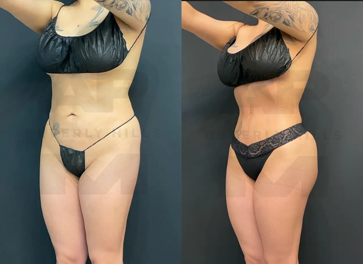 reverse-tummy-tuck-MR-02