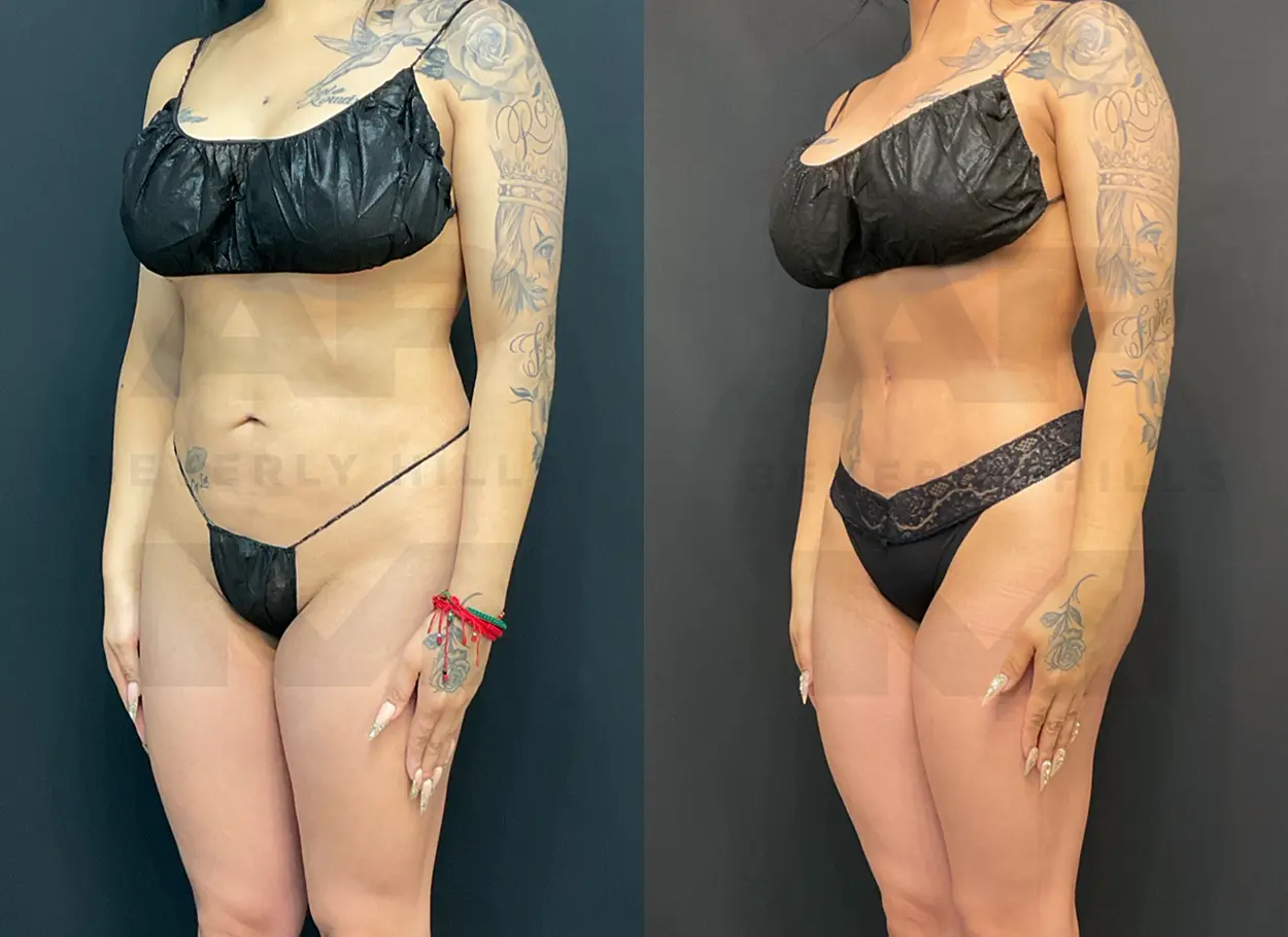 reverse-tummy-tuck-MR-03