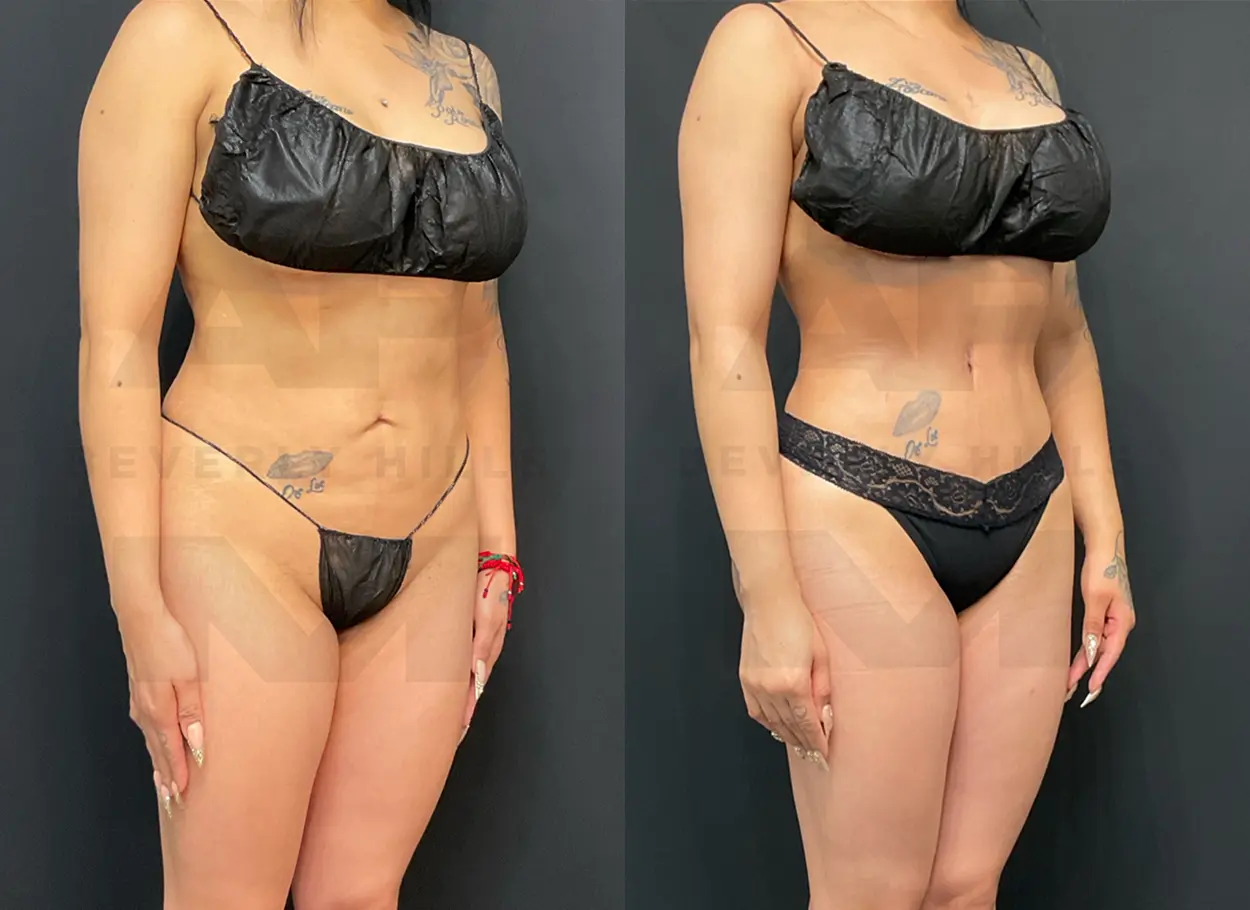 reverse-tummy-tuck-MR-05
