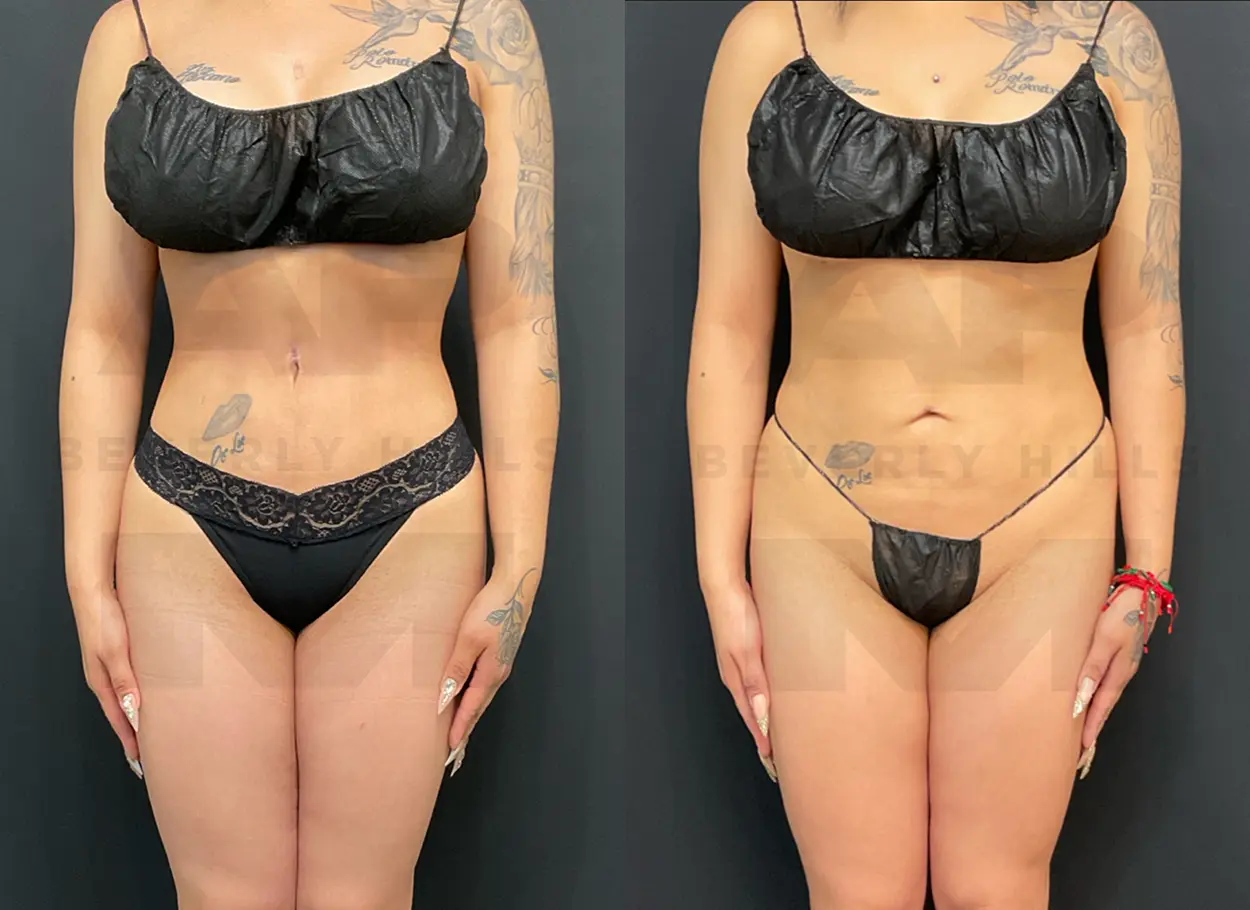 reverse-tummy-tuck-MR-06