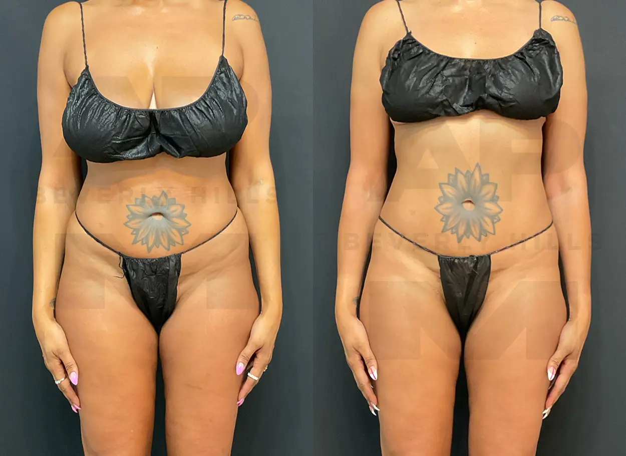 reverse-tummy-tuck-SW-01