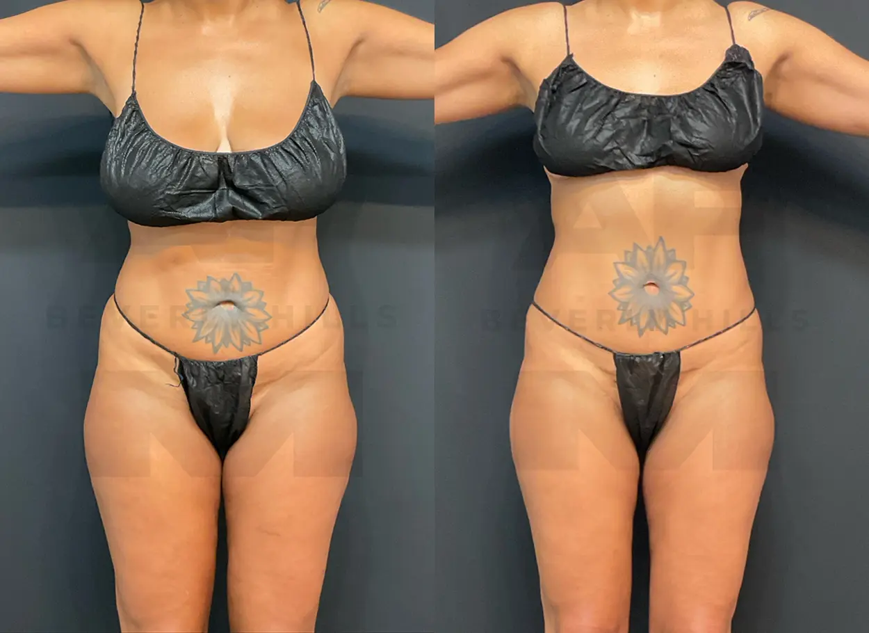 reverse-tummy-tuck-SW-02