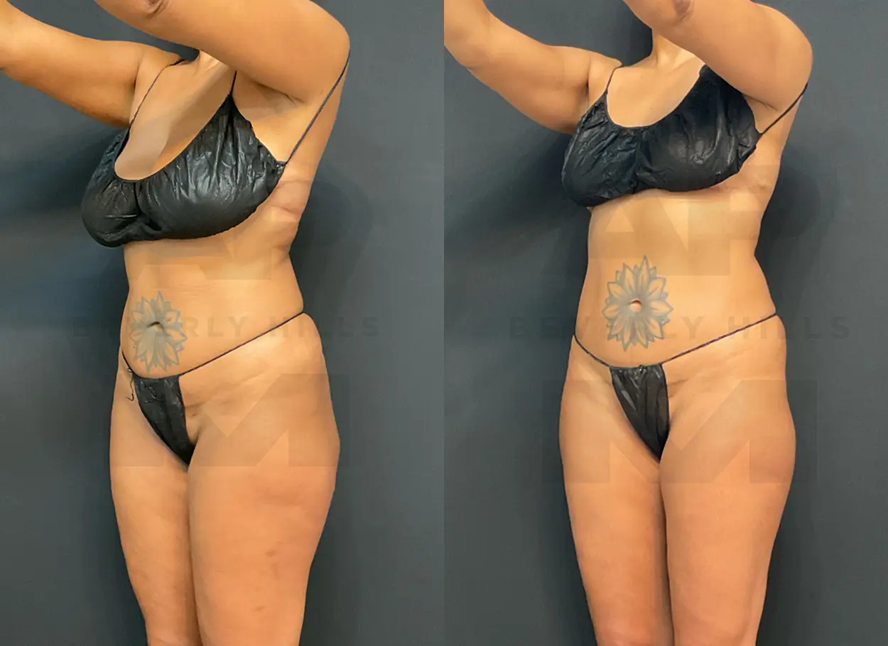 reverse-tummy-tuck-SW-03
