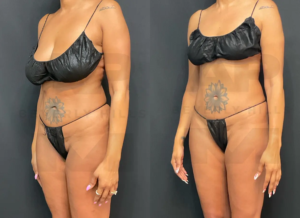 reverse-tummy-tuck-SW-04