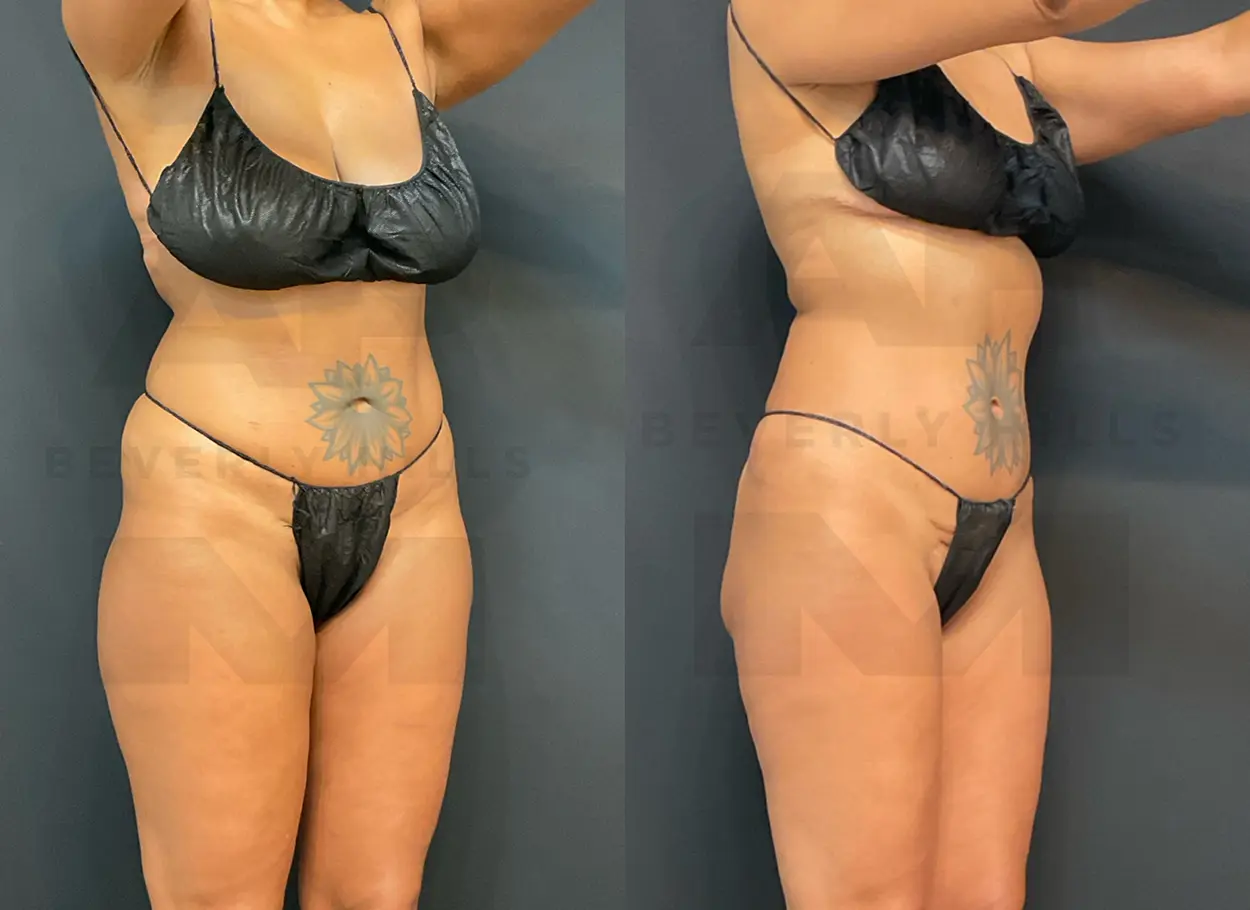 reverse-tummy-tuck-SW-05