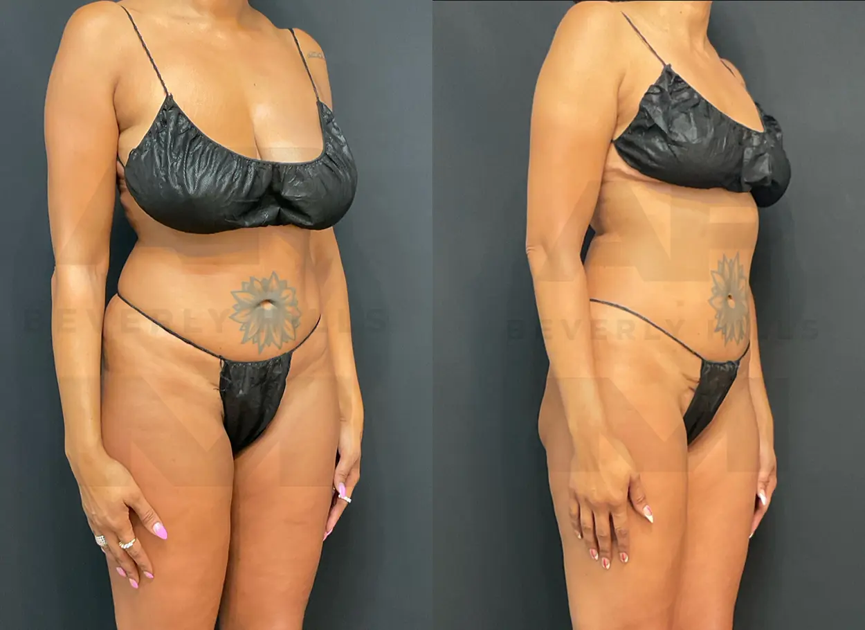 reverse-tummy-tuck-SW-06