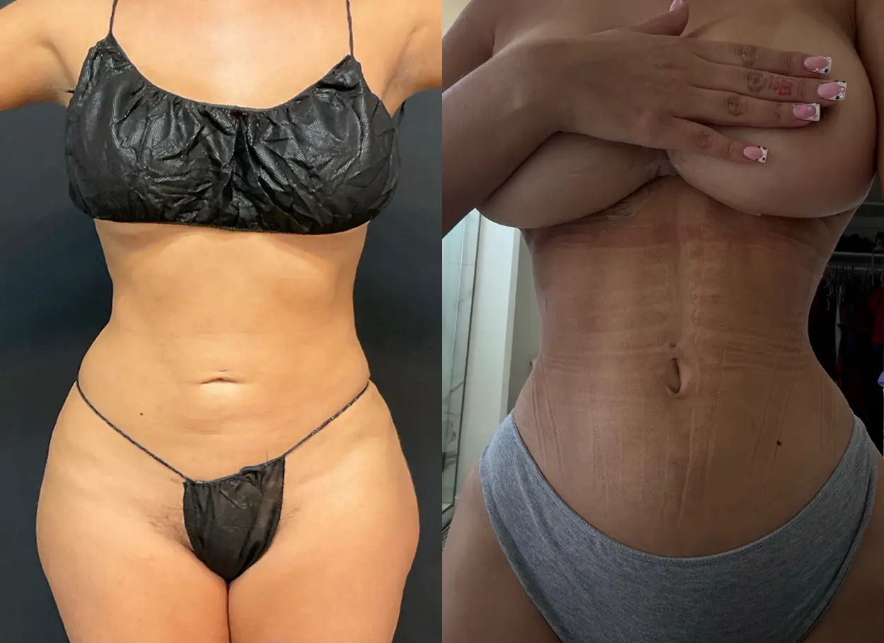 reverse-tummy-tuck-p01-01