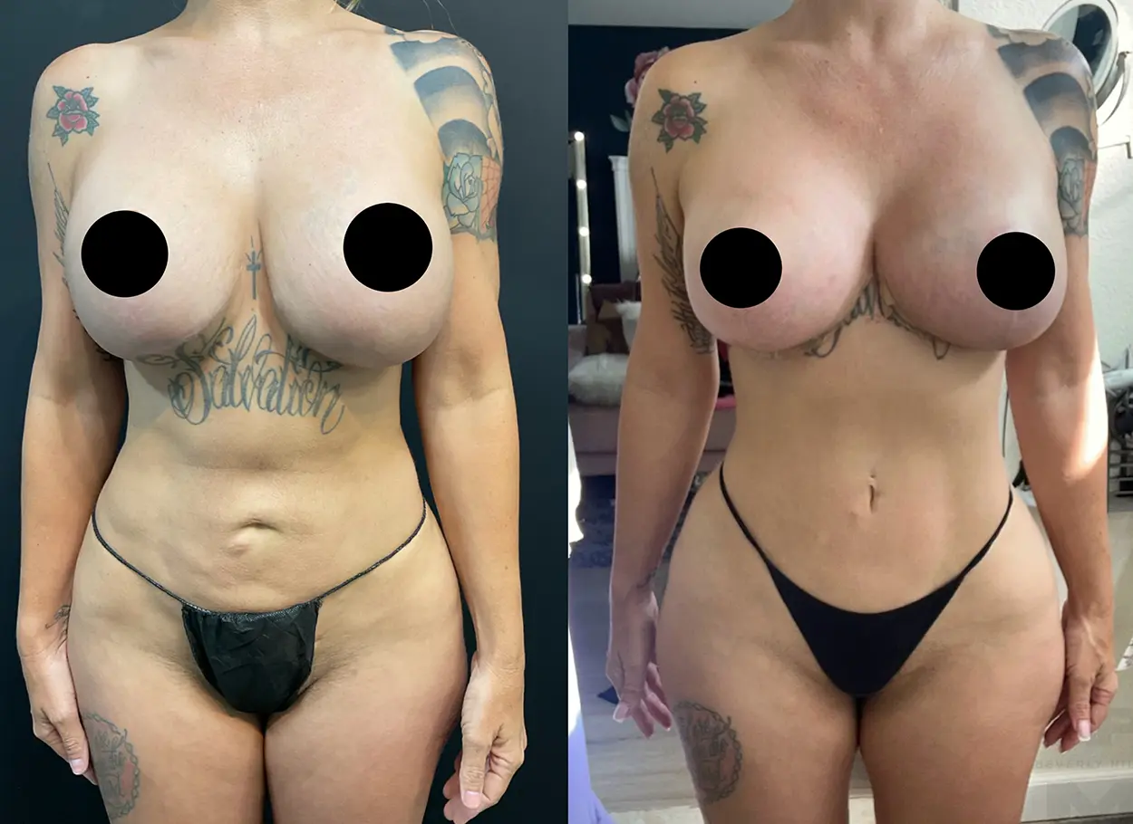 reverse-tummy-tuck-p03-01