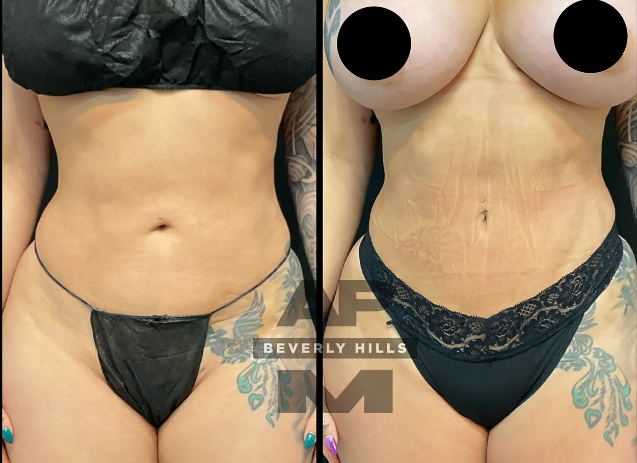 reverse-tummy-tuck-p03-02