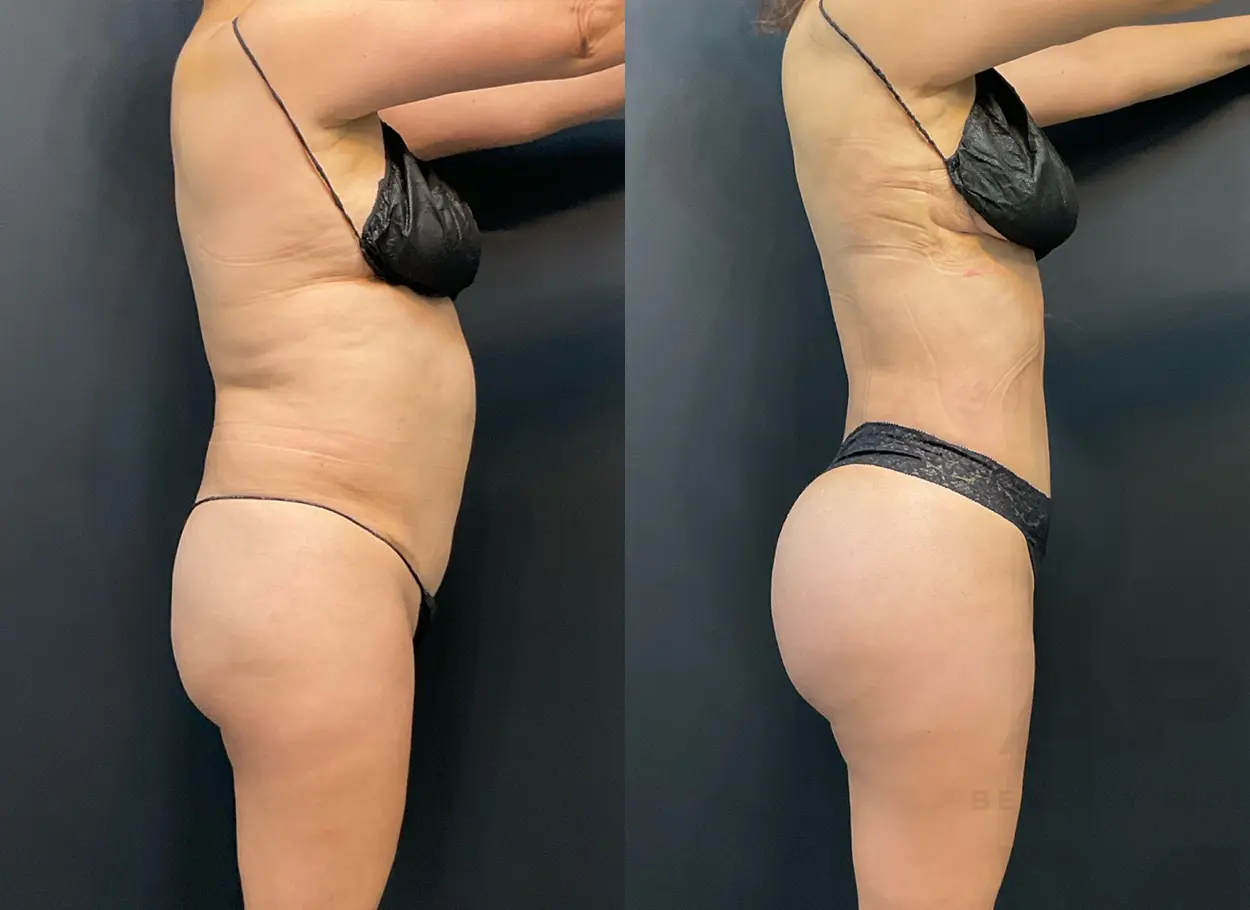 reverse-tummy-tuck-p04-01