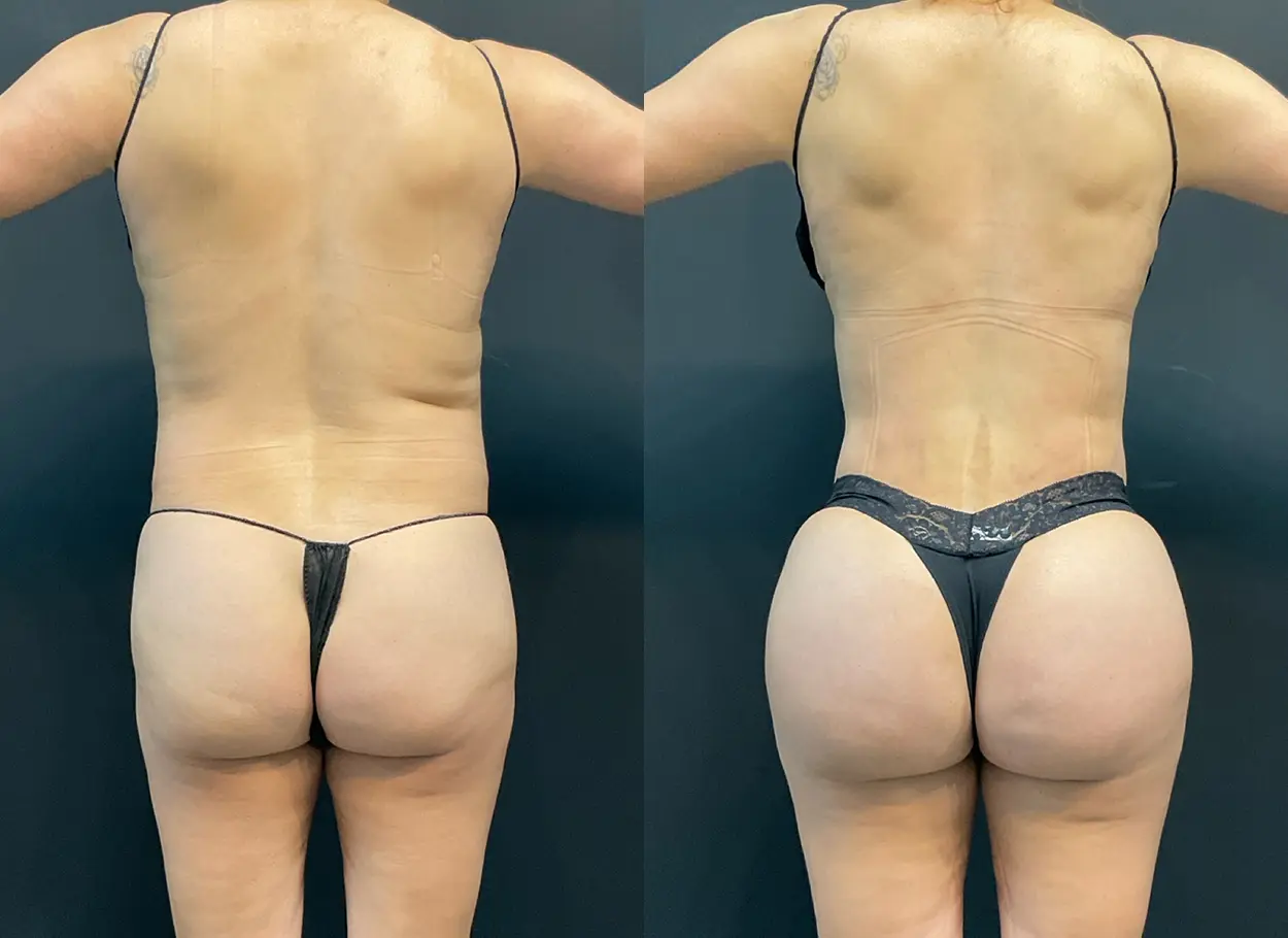 reverse-tummy-tuck-p04-02
