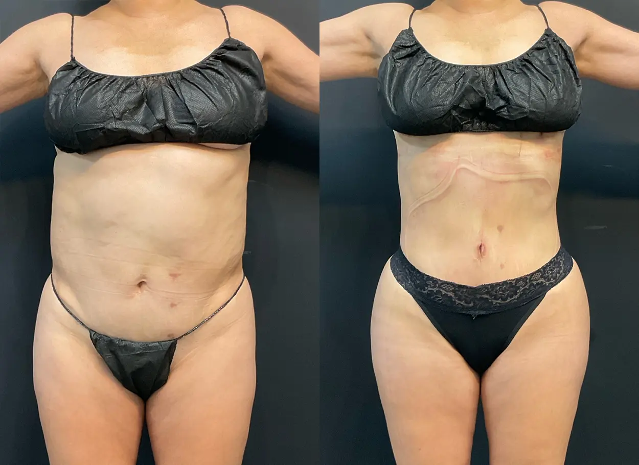 reverse-tummy-tuck-p04-03