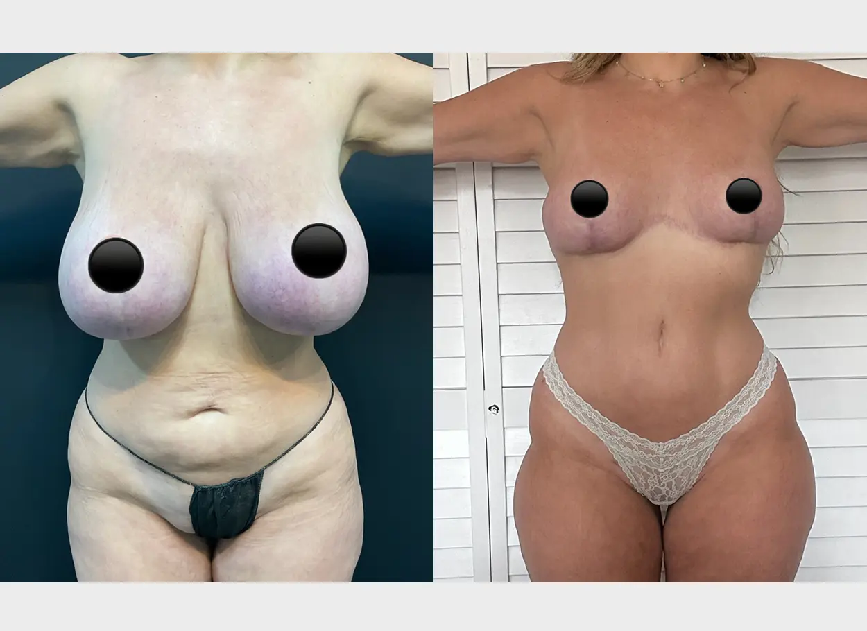 reverse-tummy-tuck-p05-01