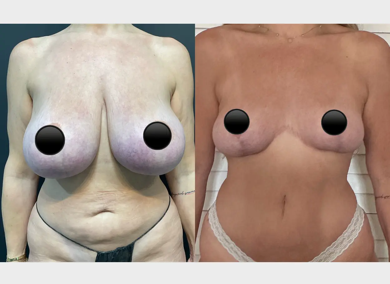 reverse-tummy-tuck-p05-02
