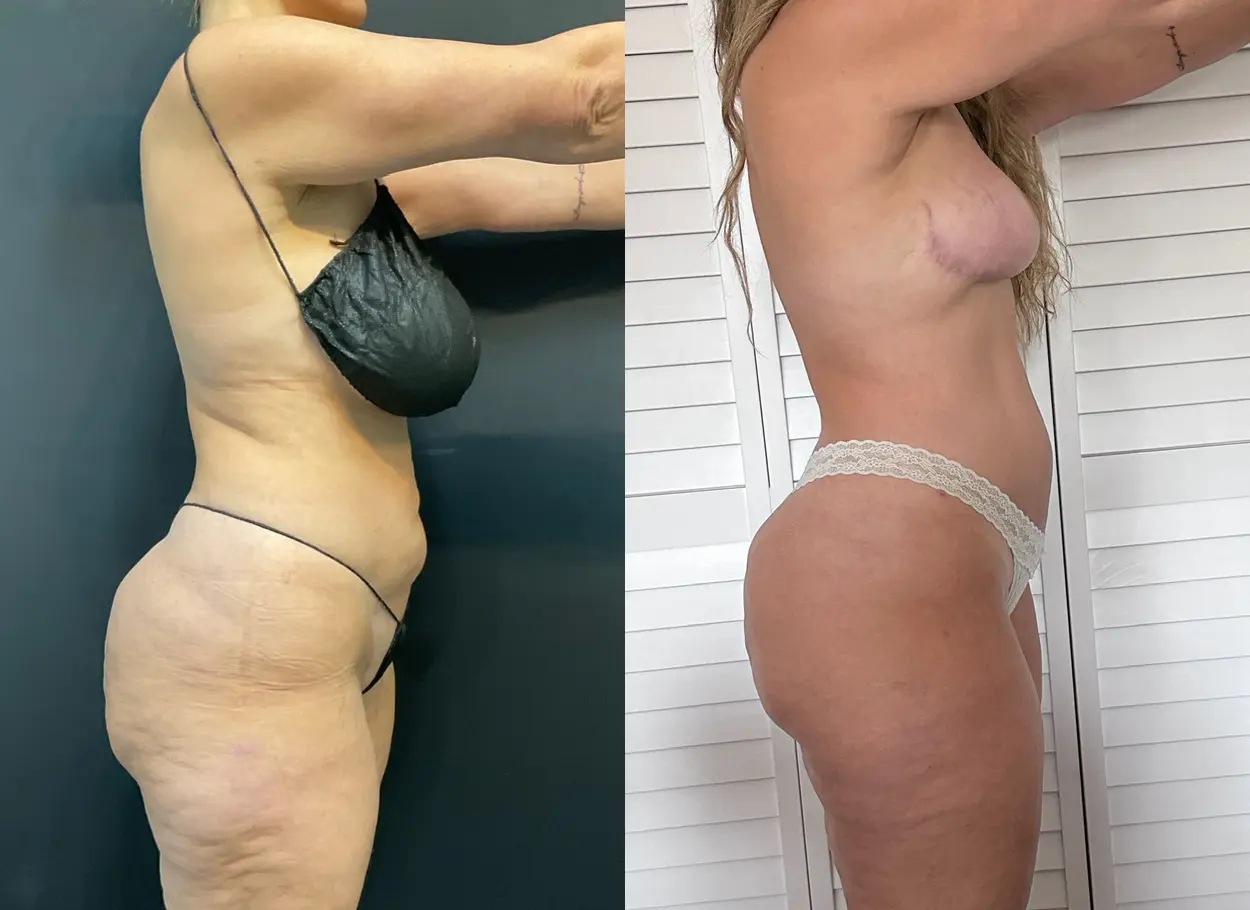 reverse-tummy-tuck-p06-01