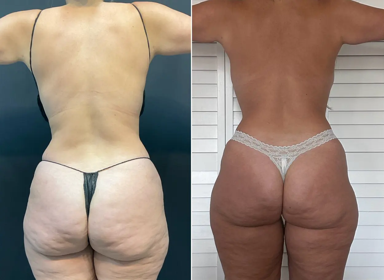reverse-tummy-tuck-p06-02