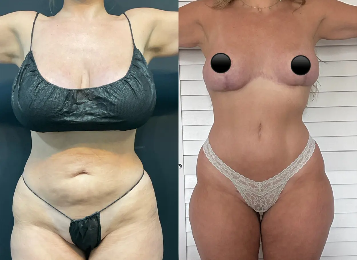 reverse-tummy-tuck-p06-03